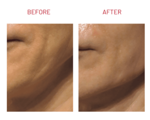 Filler_jawlinw-filler