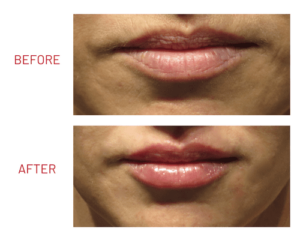 filler_lips_one