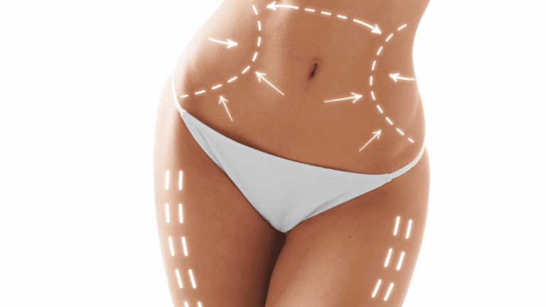 Liposuction vs. TruSculpting: Which Fat Removal Option Is Best?