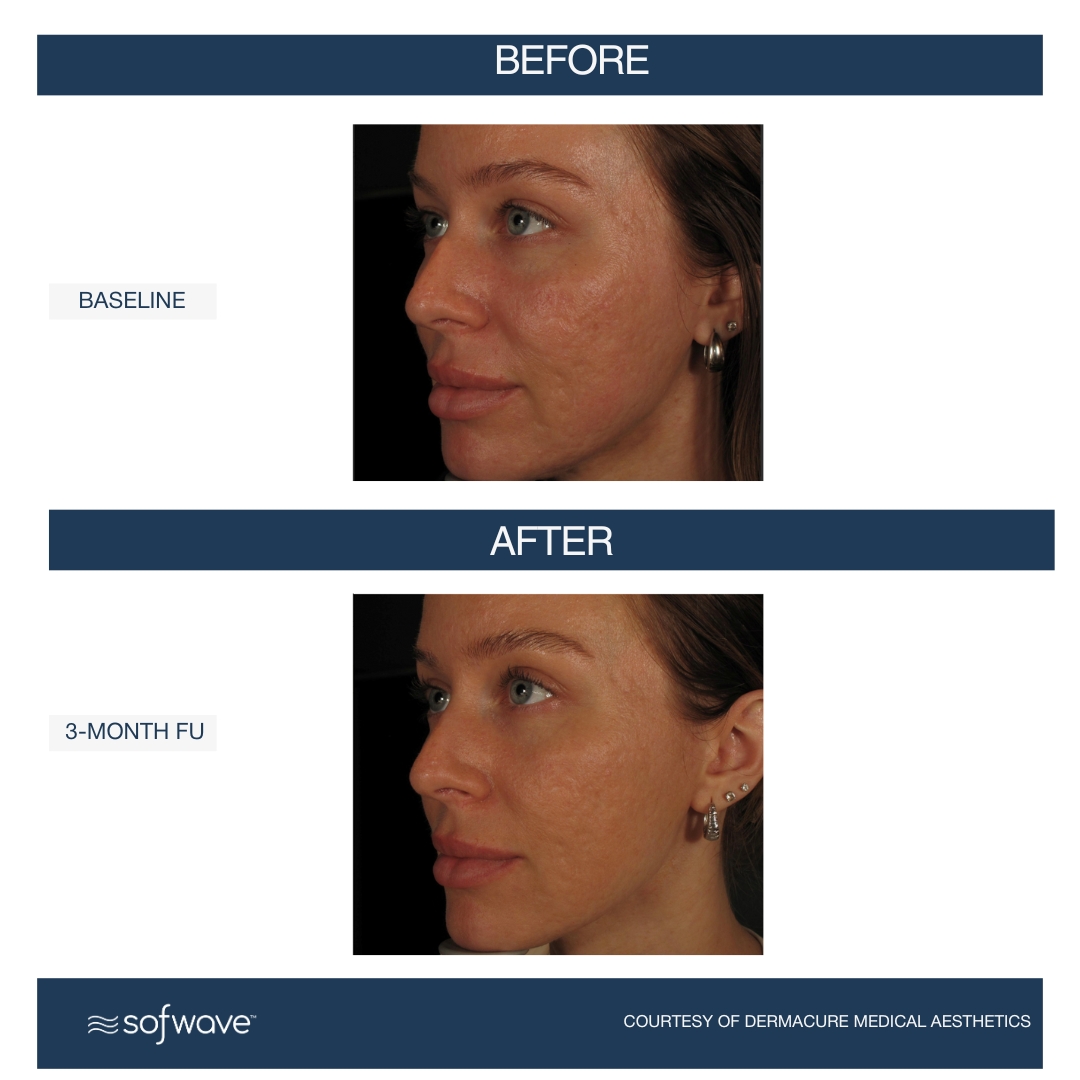 Set-105-Acne-Scars