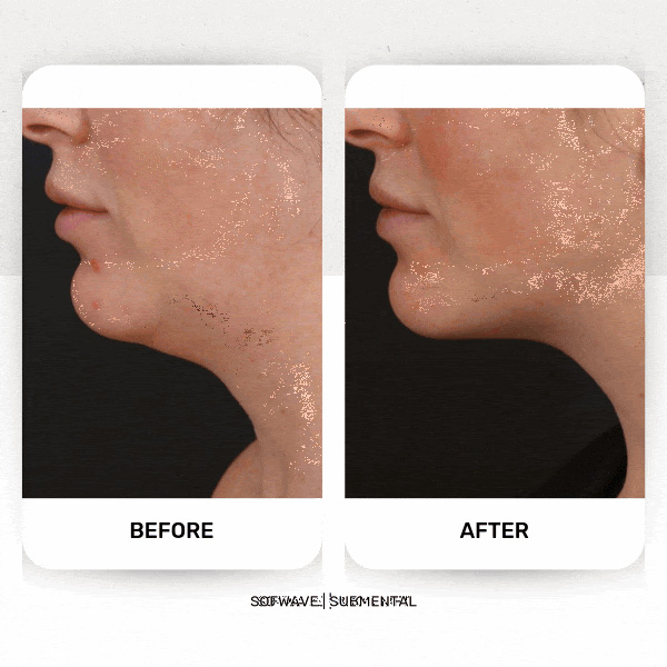 chin-sofwave