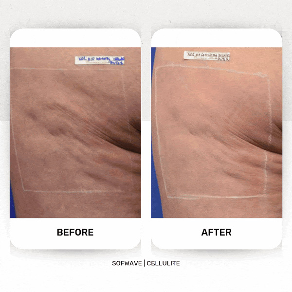 sofwave-back-thigh