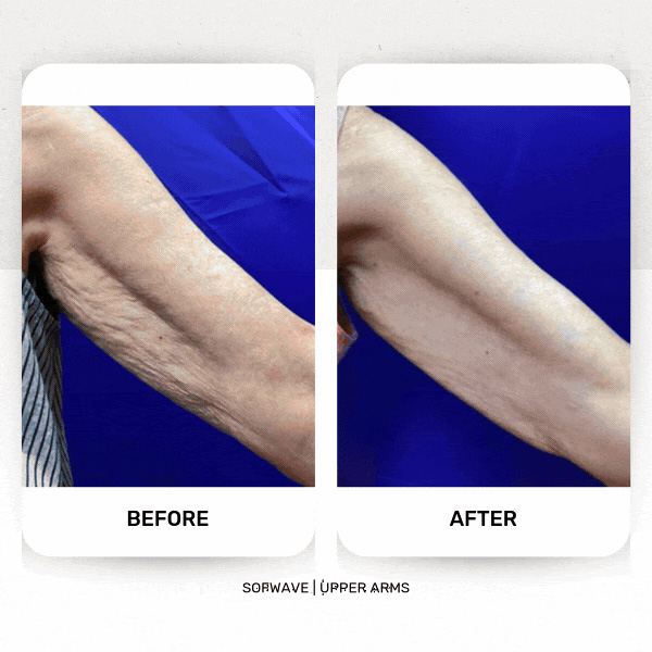 under-arm