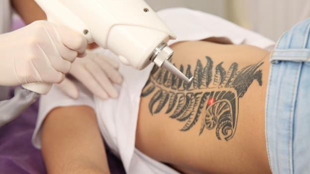 Laser Tattoo Removal vs. Tattoo Lightening: Which Option Fits Your Goals?