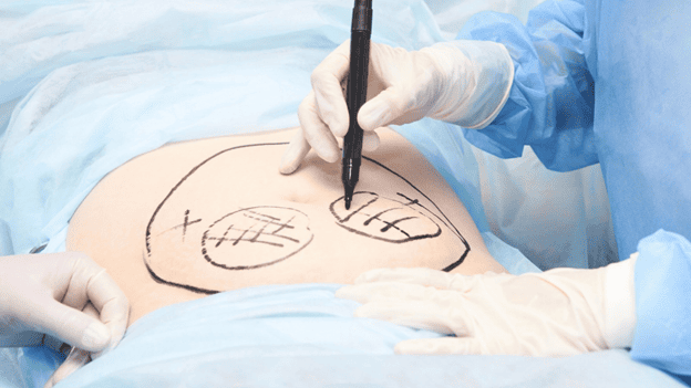Provider marking a patient’s abdomen before liposuction at Revive Wellness Centers in Palm Springs, CA
